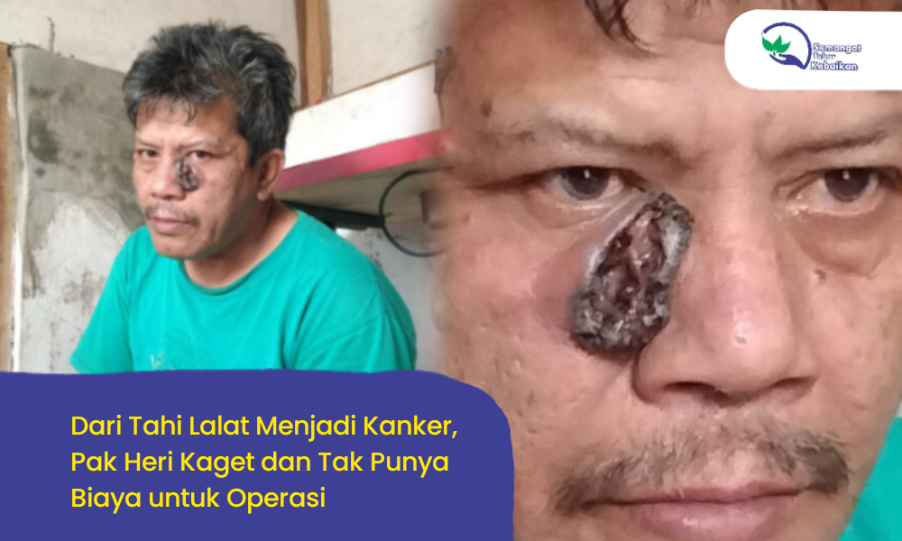 Tak Menyangka! Tahi Lalat Pak Heri Berubah Menjadi Kanker Berlubang dan Harus Segera Operasi