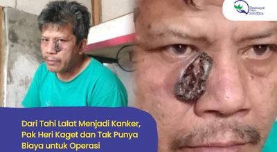 Tak Menyangka! Tahi Lalat Pak Heri Berubah Menjadi Kanker Berlubang dan Harus Segera Operasi