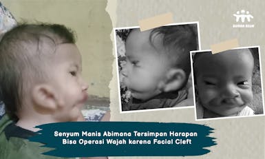 Bantu Si Kecil Abimana Operasi Wajah
