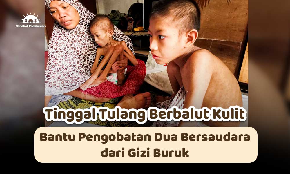 Rizal dan Muzni Alami Gizi Buruk