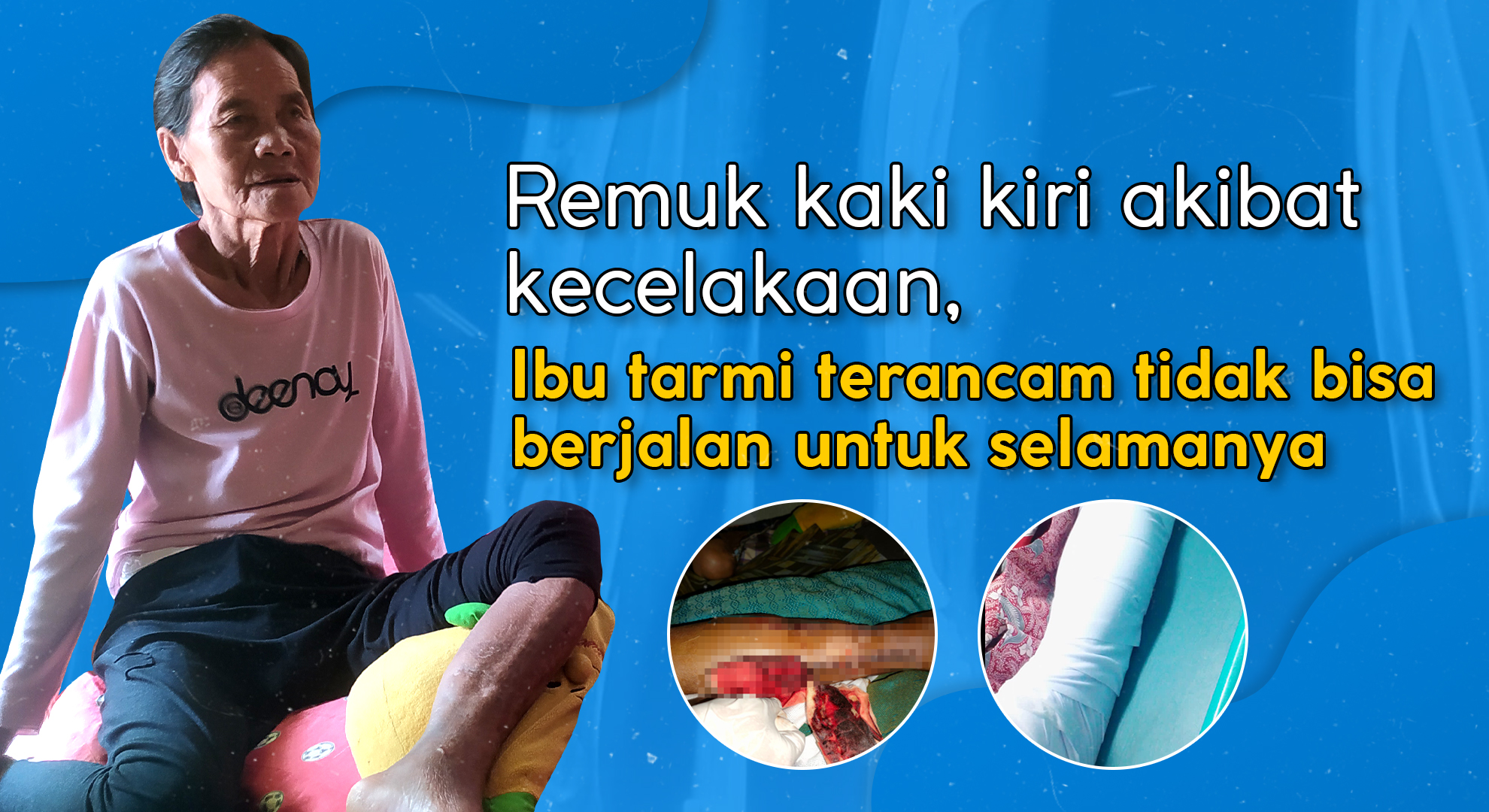 Ma Tarmi, Nenek 64 Tahun Remuk Kaki