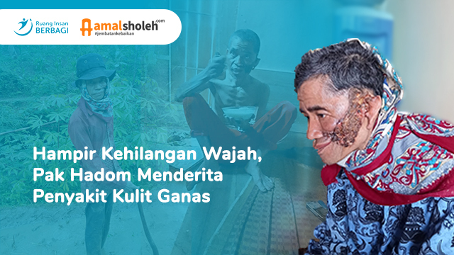 Hampir Kehilangan Wajah, Pak Hadom Menderita Penyakit Kulit Ganas