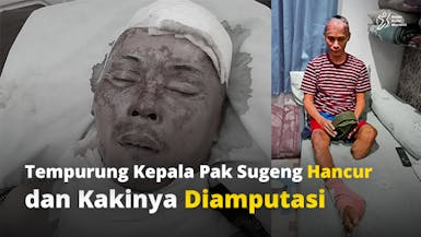 Kaki Palsu untuk Pak Sugeng, Buruh Bangunan yang Tersengat Listrik