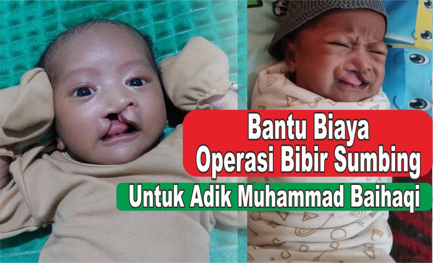 Bantu Biaya Operasi untuk bayi Sumbing