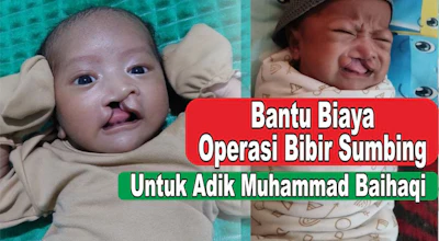 Bantu Biaya Operasi untuk bayi Sumbing