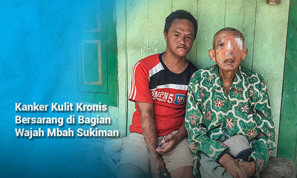 Bantu Pengobatan Kanker Kulit yang Diderita Mbah Sukiman Pada Bagian Wajahnya
