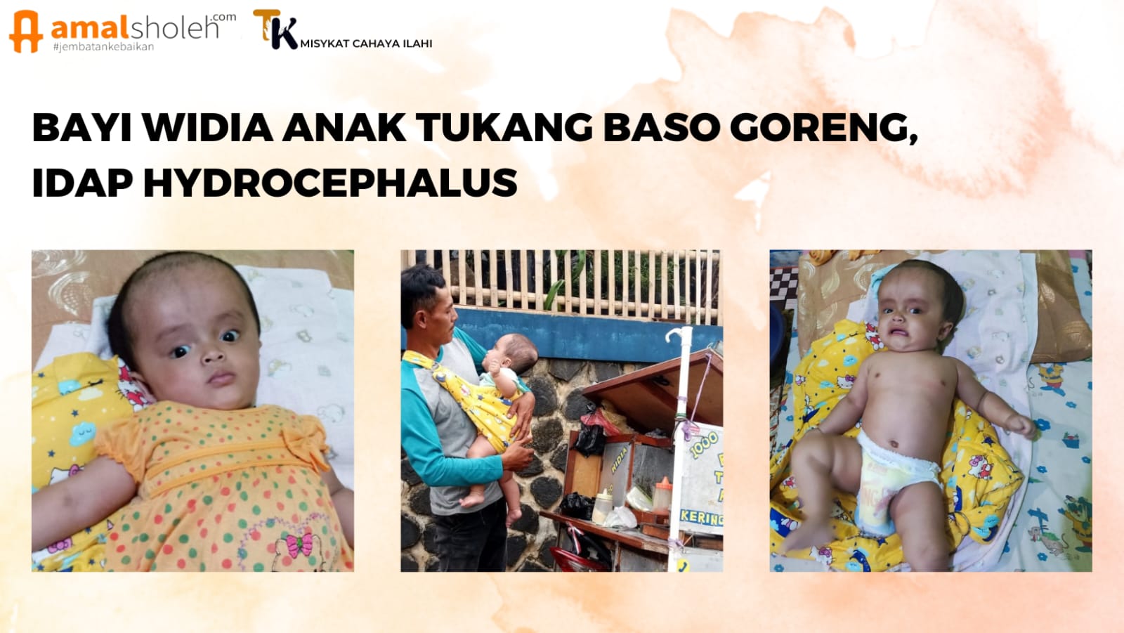 BAYI WIDIA ANAK TUKANG BASO GORENG, IDAP HYDROCEPHALUS