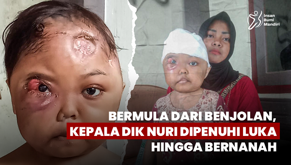 Bermula dari Benjolan, Kepala Dik Nuri Dipenuhi Luka Hingga Bernanah