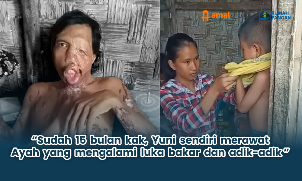 Akibat Alami Luka Bakar, Yuni Menggantikan Peran Sang Ayah
