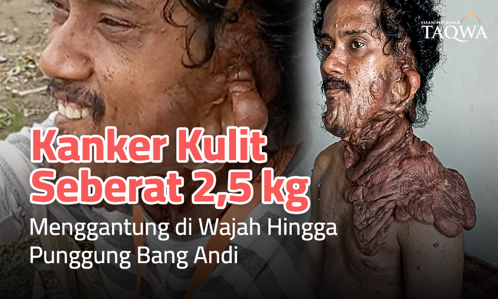 Bantu Ringankan Beban Bang Andi untuk Tempuh Kesembuhan