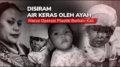 80% Wajah Melepuh Disiram Air Keras Oleh Ayah