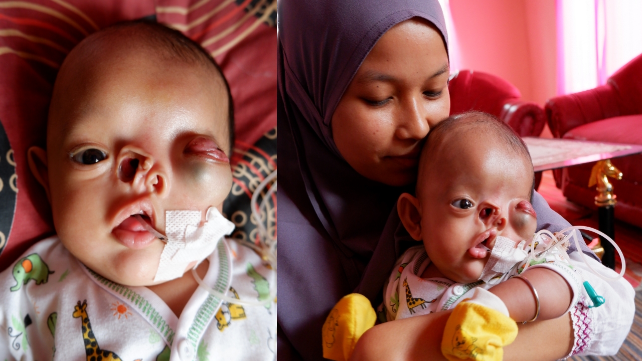 Pilu! Bayi Ini Bertahan Hidup dari Selang Makanan!