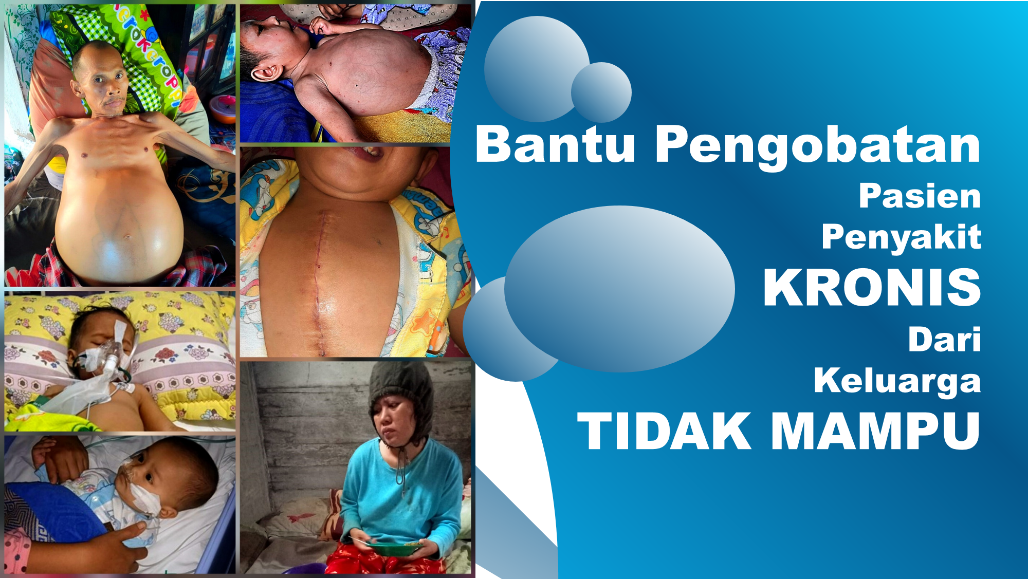 Bantu Biaya pasien Penyakit Kronis TIDAK MAMPU