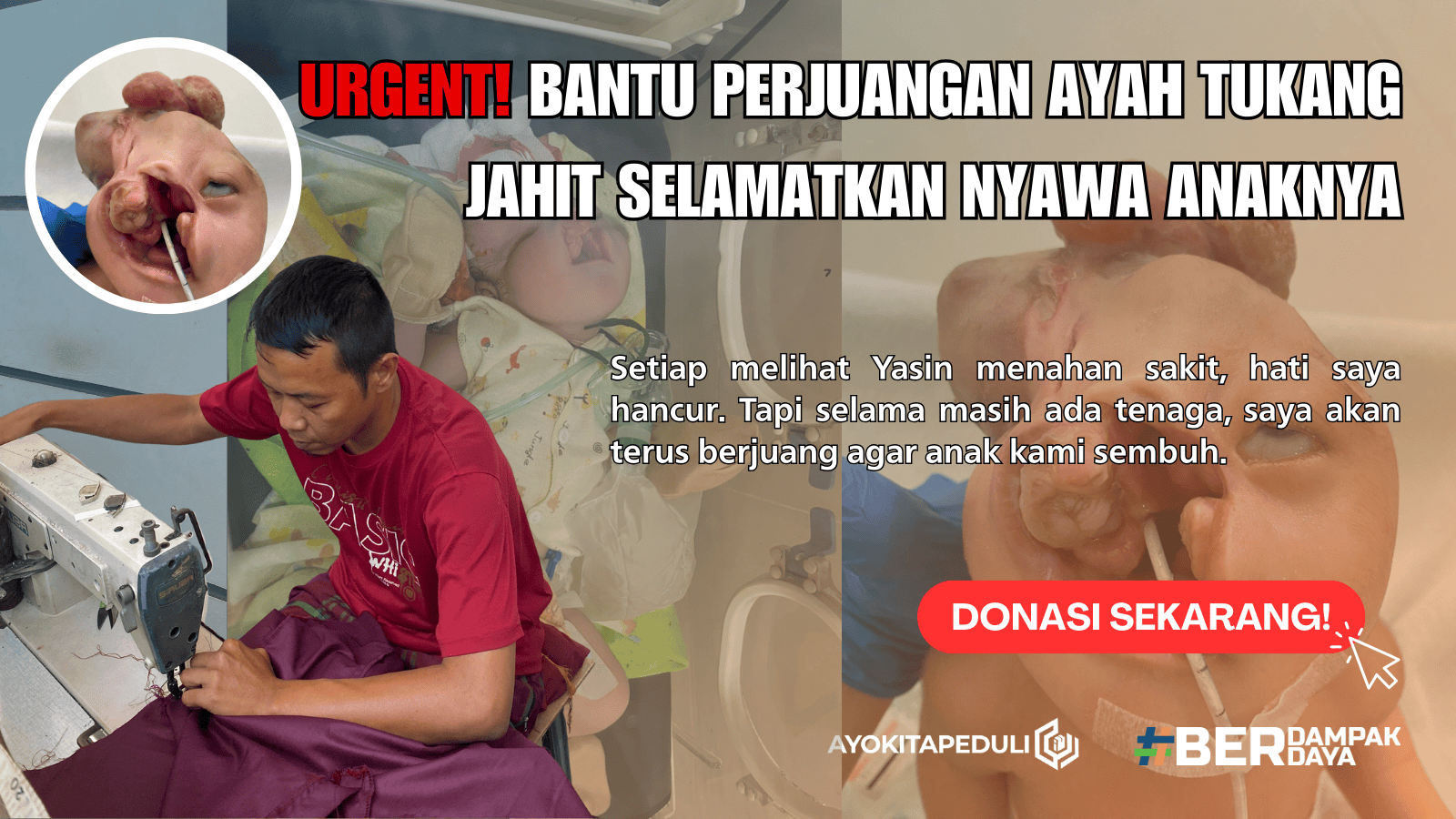 URGENT!!! Bantu Anak Penjahit Ini Bertahan Hidup Tanpa Tempurung Kepala