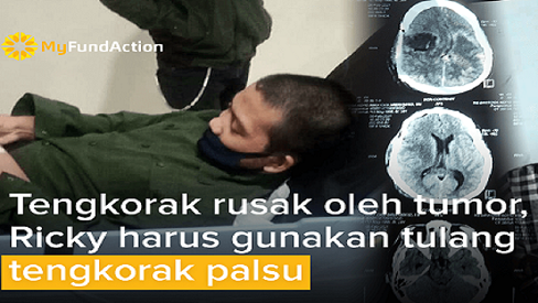 Ricky, Anak Yatim Pejuang Tumor