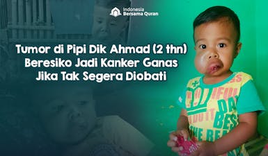 Bantu Dik Ahmad (2 thn) Sembuh dari Tumor Pipi Sebesar Kepalan Tangan