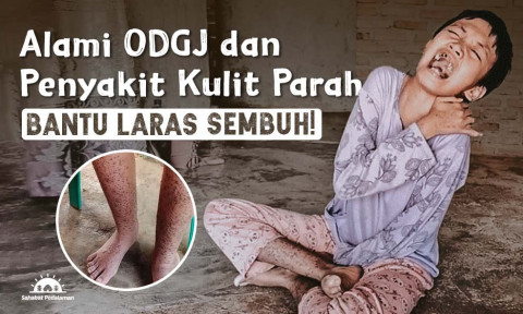 17 Tahun Alami Penyakit Kulit, Kondisi Laras Semakin Memburuk