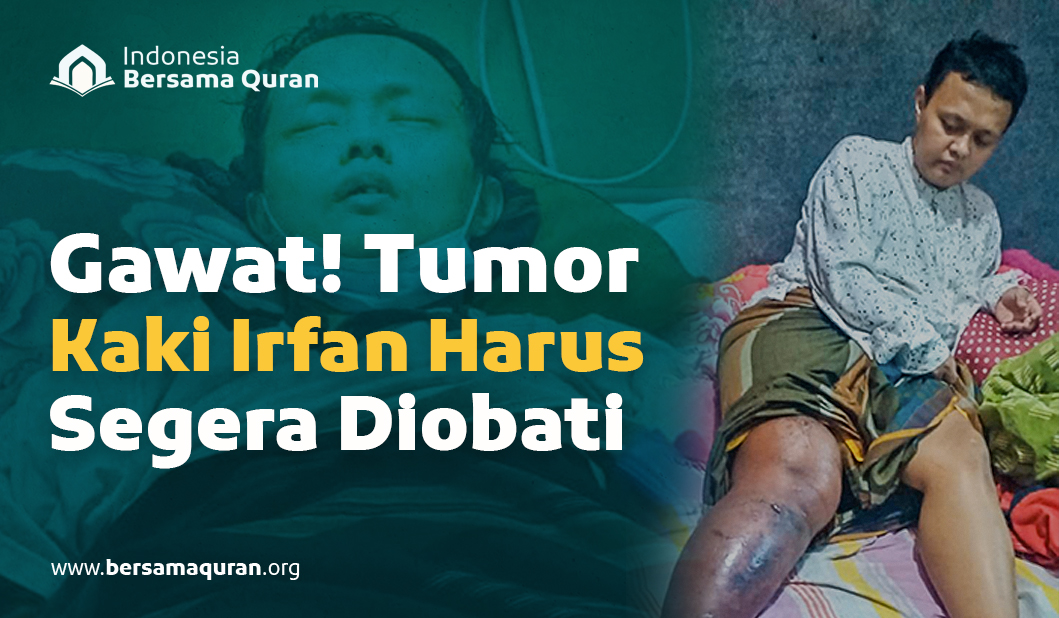 Gawat! Tumor Kaki Irfan Harus Segera Diobati