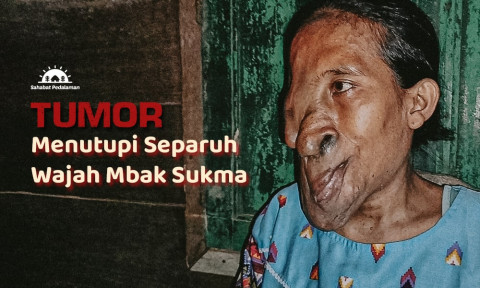 36 Tahun Alami Tumor, Bantu Mbak Sukma Sembuh