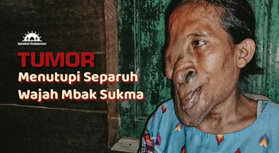 36 Tahun Alami Tumor, Bantu Mbak Sukma Sembuh