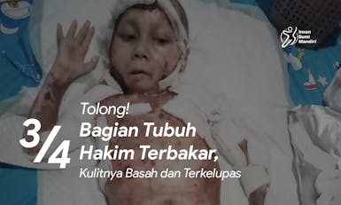 Tolong! Hakim (6 tahun) Terbakar Hampir Seluruh Tubuh