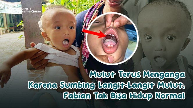 Bantu Fabian Wujudkan Operasi Sumbing Langit-Langit dan Hidrosefalus