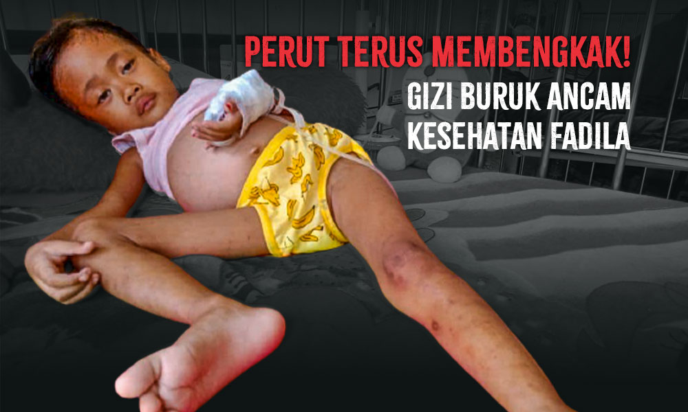 Perut Terus Membengkak! Gizi Buruk Ancam Kesehatan Fadila