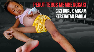 Perut Terus Membengkak! Gizi Buruk Ancam Kesehatan Fadila