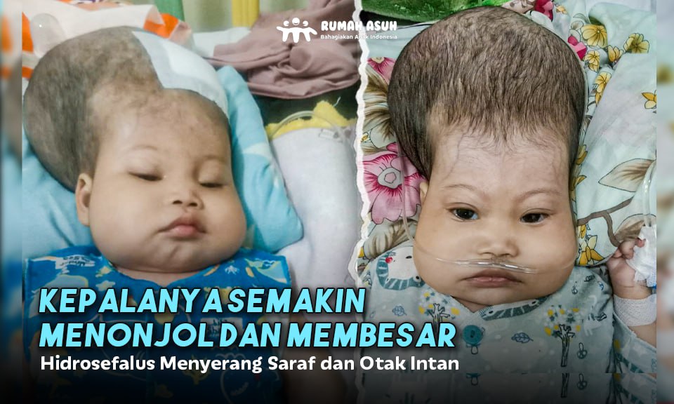 Semakin Membesar dan Bernanah! Bantu Intan Berjuang Lawan Hidrosefalus