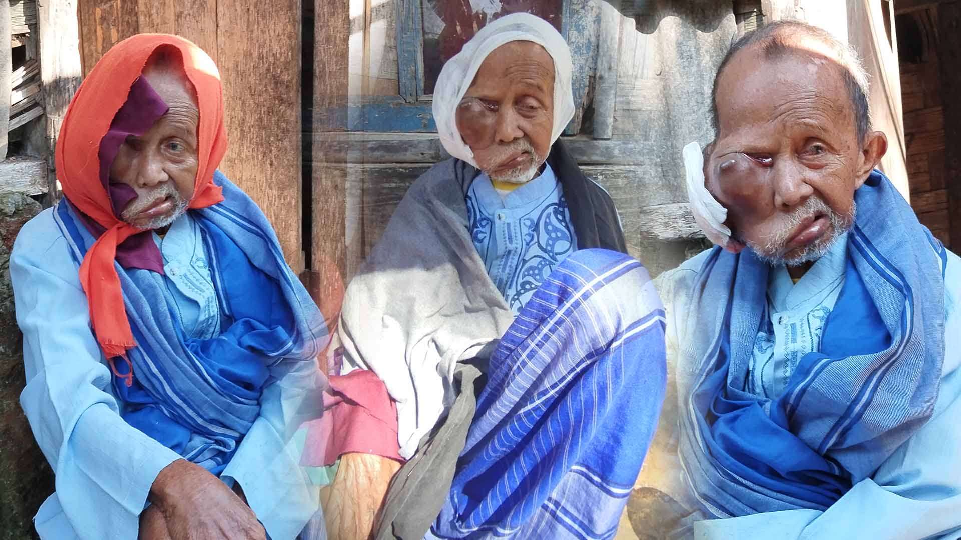 Urgent! Benjolannya Pecah dan Membesar, Pandangan Abah Tertutup Tumor