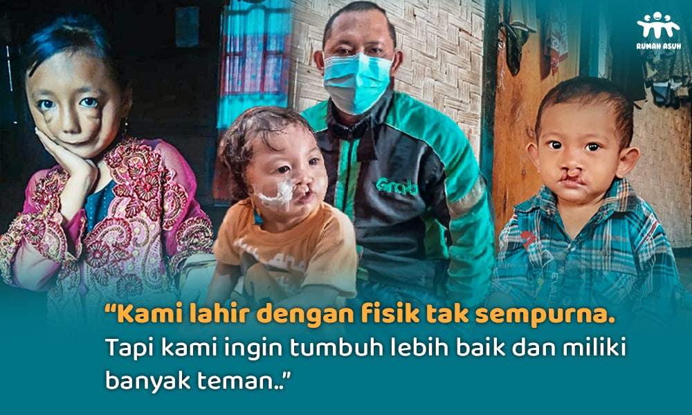 Temani Perjuangan Adik Yatim dan Dhuafa Pengidap Facial Cleft dan Bibir Sumbing