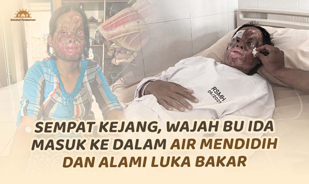 Wajah Alami Luka Bakar, Bu Ida Harus Segera Dioperasi