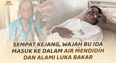 Wajah Alami Luka Bakar, Bu Ida Harus Segera Dioperasi