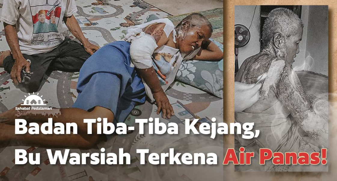 Bu Warsiah Terkena Luka Bakar Parah Akibat Epilepsi!