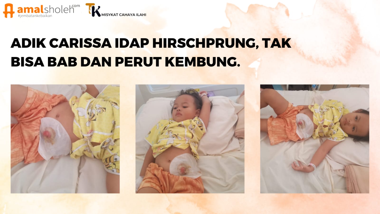 ADIK CARISSA IDAP HIRSCHPRUNG, TAK BISA BAB DAN PERUT KEMBUNG