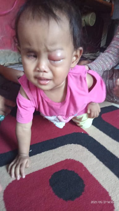 Butuh Uluran Tangan, Khansa Bocah 14 Bulan Divonis Menderita Kanker Mata