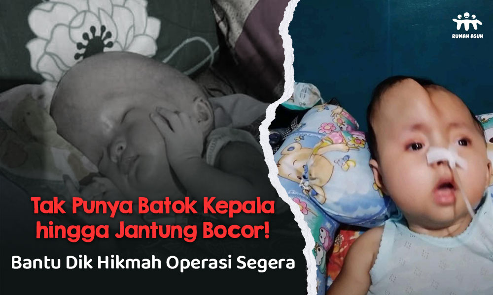 Gawat! Hikmah (2th) Alami Komplikasi Hirosefalus, Infeksi Paru, hingga Jantung Bocor