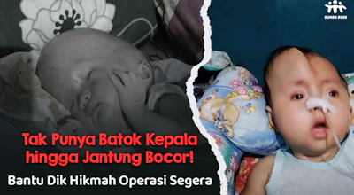 Gawat! Hikmah (2th) Alami Komplikasi Hirosefalus, Infeksi Paru, hingga Jantung Bocor