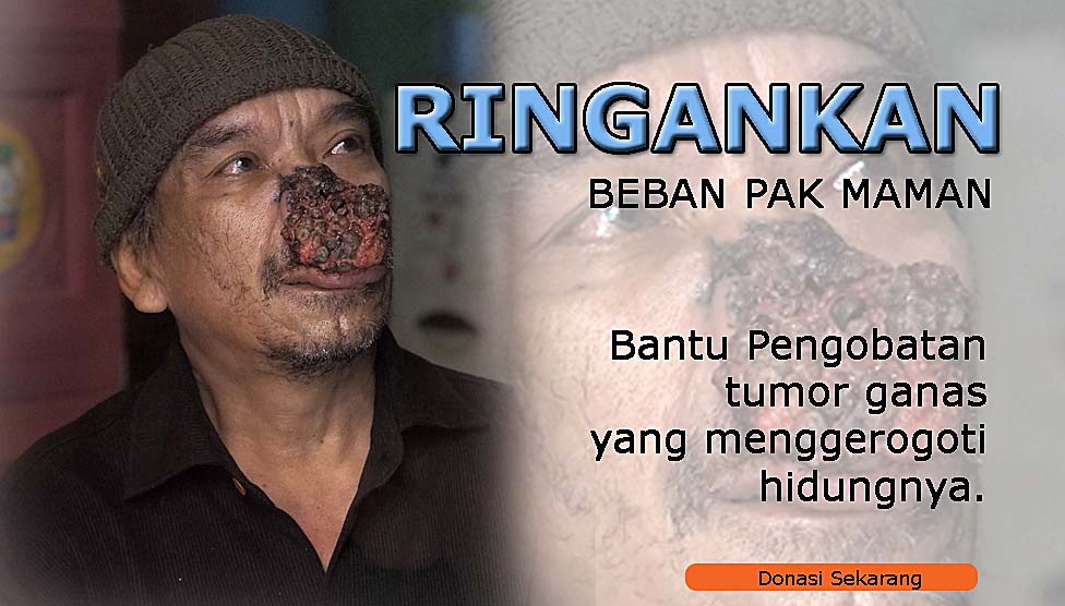 Mendesak, Bantu Operasi Tumor Hidung Pak Maman
