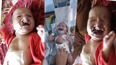 Kelainan Jantung dan Sumbing Bibir Ketika Lahir Wildan (6bulan) Anak Buruh Tani Butuh Penaganan Medis Segera