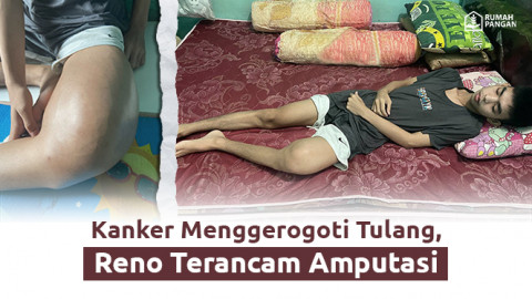 Kanker Tulang, Selamatkan Reno dari Ancaman Amputasi