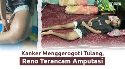 Kanker Tulang, Selamatkan Reno dari Ancaman Amputasi