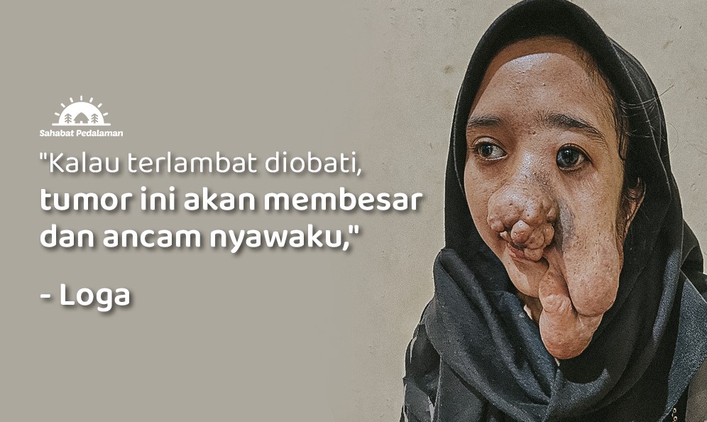 Setengah Wajah Tertutupi Benjolan, Tumor Ancam Nyawa Loga