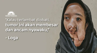 Setengah Wajah Tertutupi Benjolan, Tumor Ancam Nyawa Loga