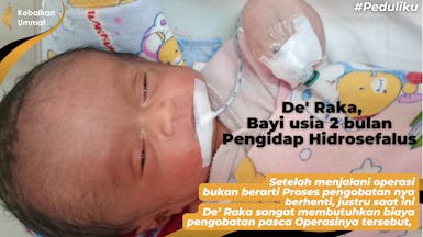 RAKA, BAYI BERUSIA 2 BULAN PENDERITA HIDROSEFALUS