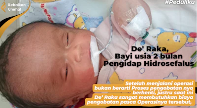 RAKA, BAYI BERUSIA 2 BULAN PENDERITA HIDROSEFALUS