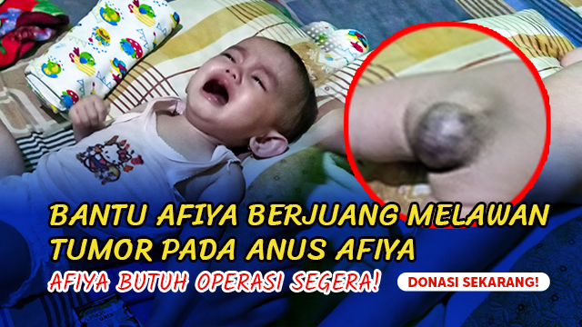 Tumor Semakin Membesar Afiya Butuh Operasi Segera