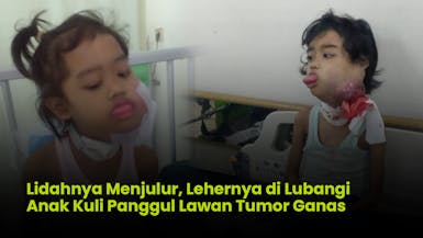 330 Hari Deliya Berjuang Melawan Tumor Ganas di Leher