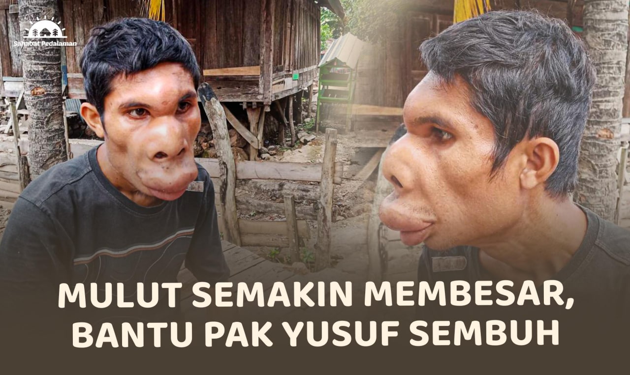 Dijauhi Karena Alami Kelainan, Pak Yusuf Ingin Sembuh