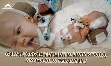 Silvi (Bayi 2 Bulan) Lahir Dengan Benjolan di Kepala
